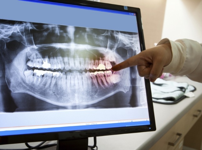 Dentist pointing to computer screen showing x rays of teeth