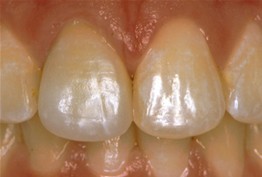 Close up of smile with lighter teeth thanks to dental crowns