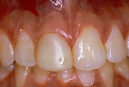 Close up of slightly discolored teeth
