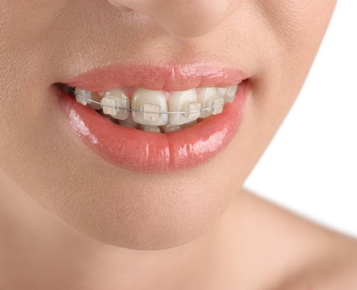 Close up of smile with clear ceramic braces