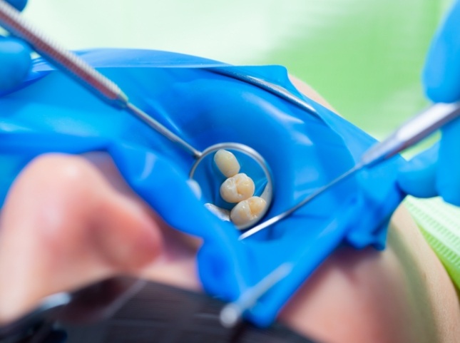 Dentist placing a tooth colored filling