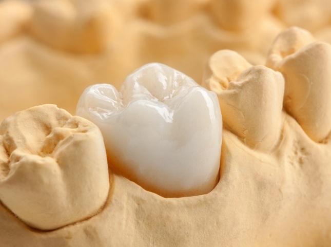 White dental crown over a tooth in a model of the mouth