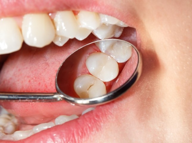 Close up of dental mirror inside of mouth