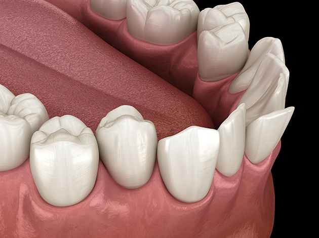 Illustration of a crooked teeth