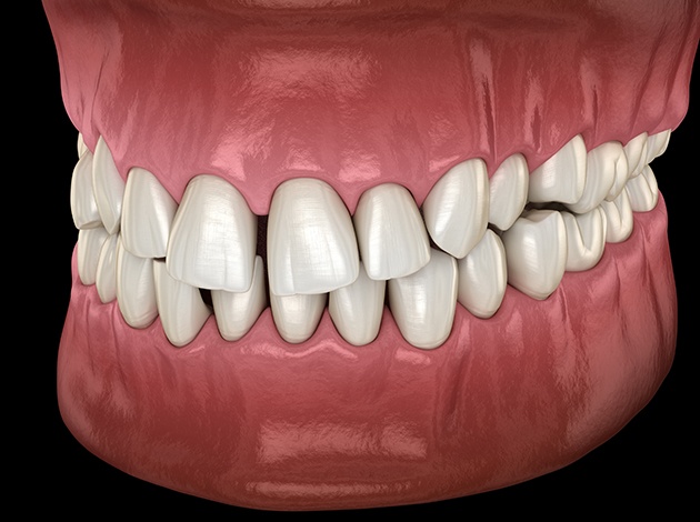 Illustration of gapped teeth