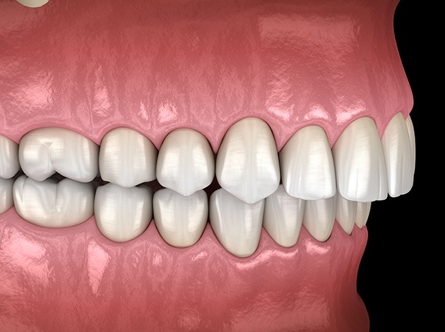 Illustration of an overbite
