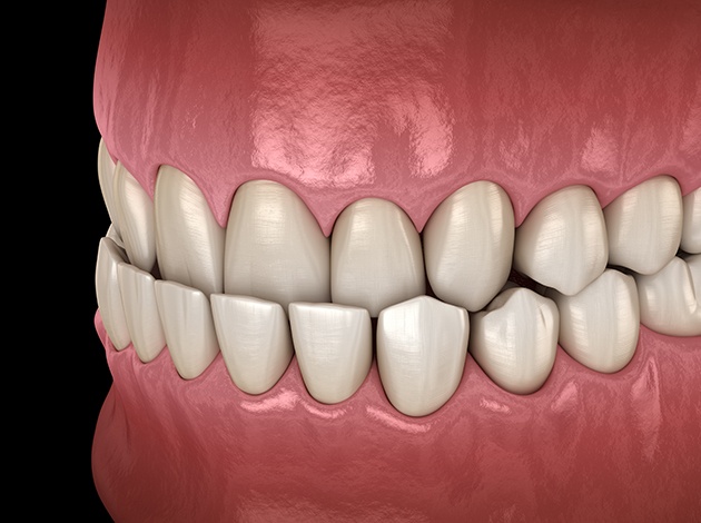 Illustration of an underbite