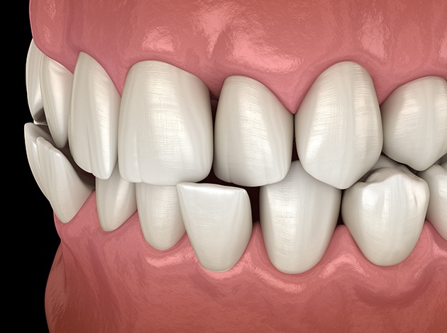 Illustration of a crossbite