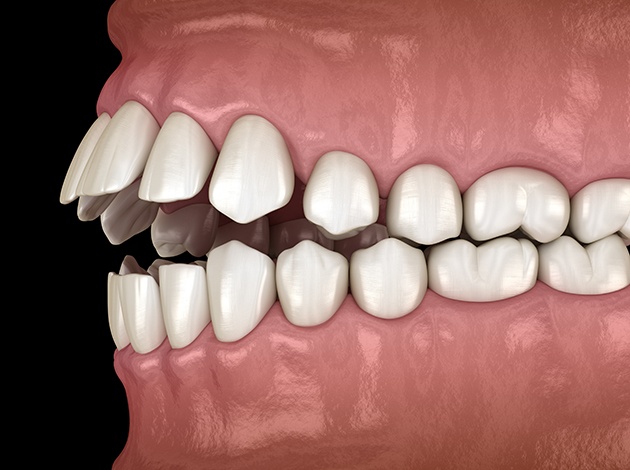 Illustration of an open bite