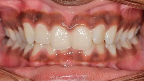 Mouth with misaligned teeth