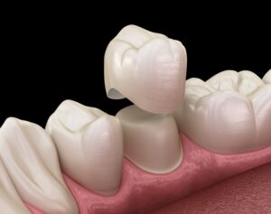 Animated dental crown fitting over tooth.